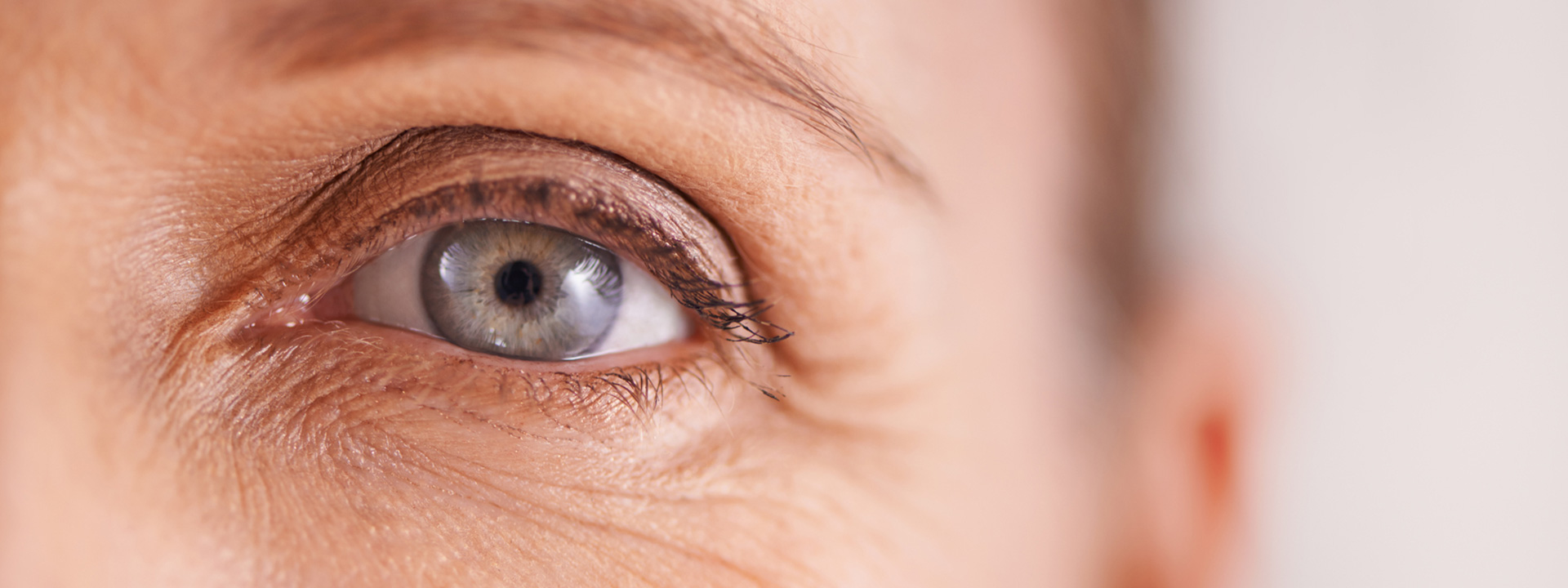 A beautiful woman before erbium resurfacing treatment.