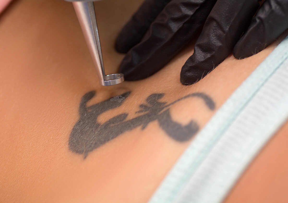 Everything you need to know about laser tattoo removal services at Andromeda Aesthetics
